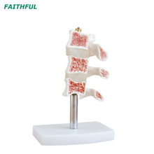 XC-134 Cutaway Osteoporosis